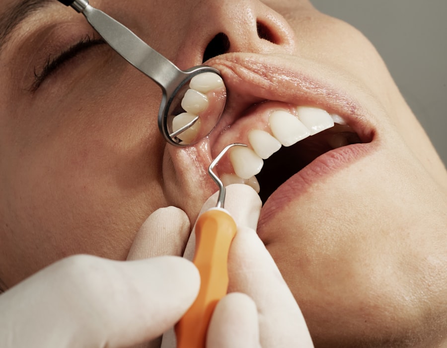 Porcelain Veneers